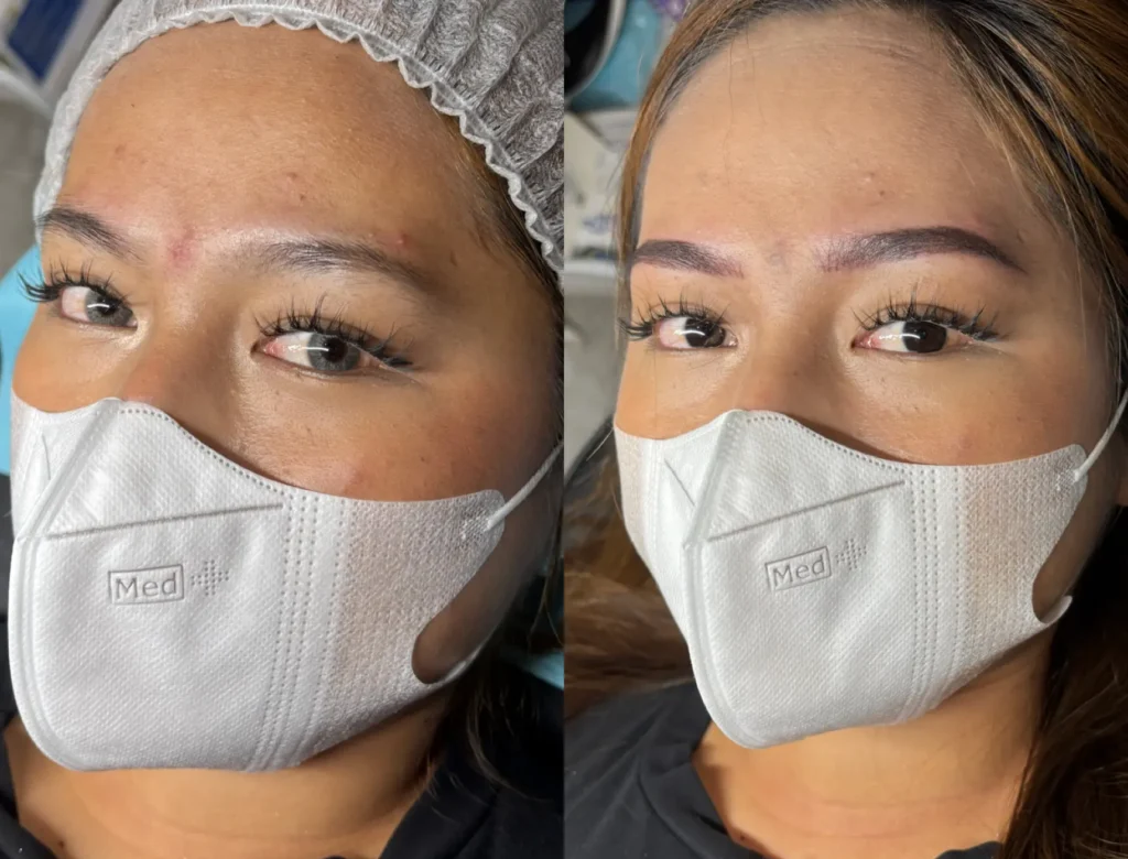 Before after sulam alis Depok di Delogy, hasil natural dan rapi sesuai bentuk wajah gambar ini untuk artikel Perbedaan Sulam Alis dan Microblading