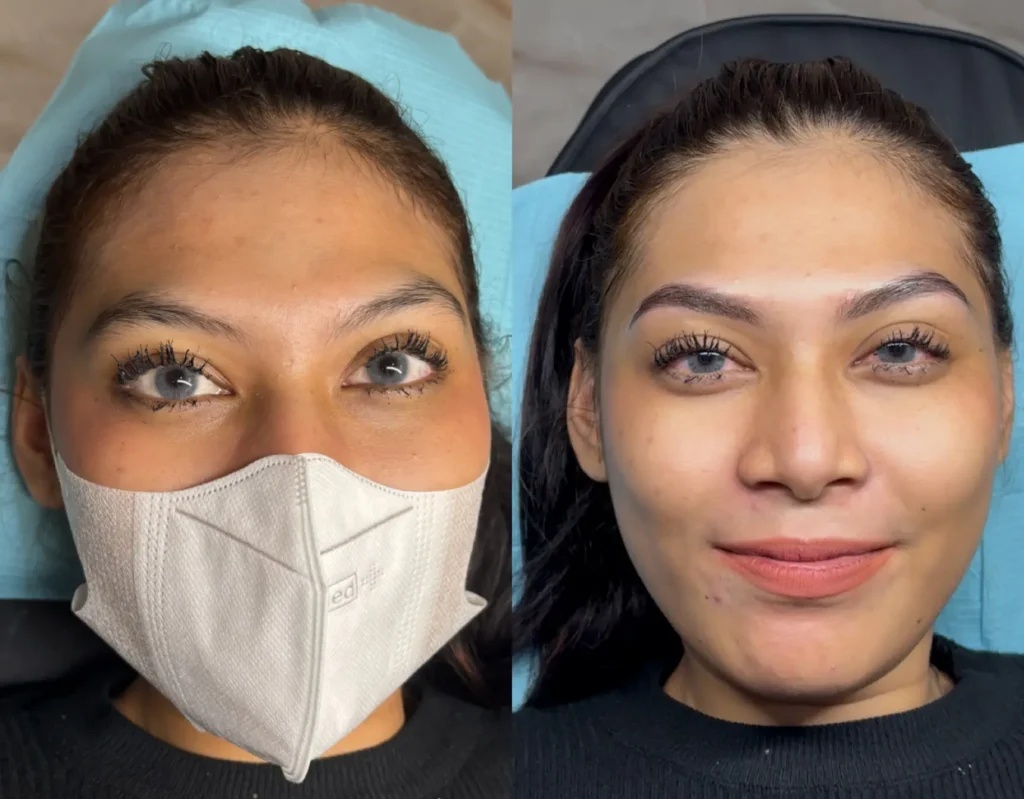 Perbandingan sebelum dan sesudah sulam alis Depok, tampilan lebih tebal dan simetris